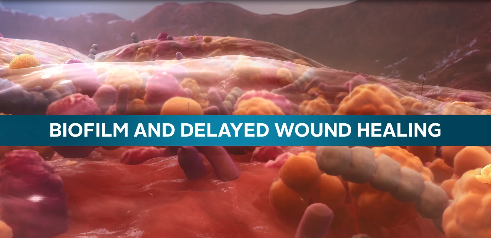 winning the battle against heard-to-heal wounds with AQUACEL ™ Ag Advantage