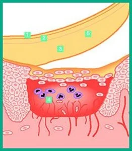 um desenho de como funcionam os pensos DuoDERM®